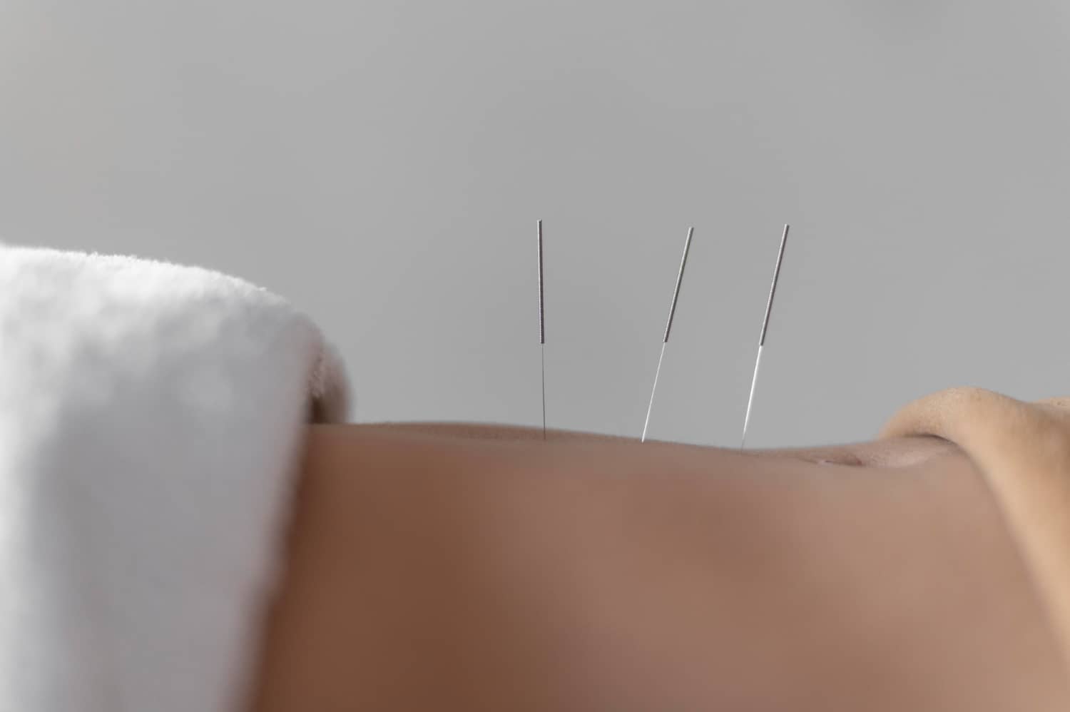 acupuncture procedure