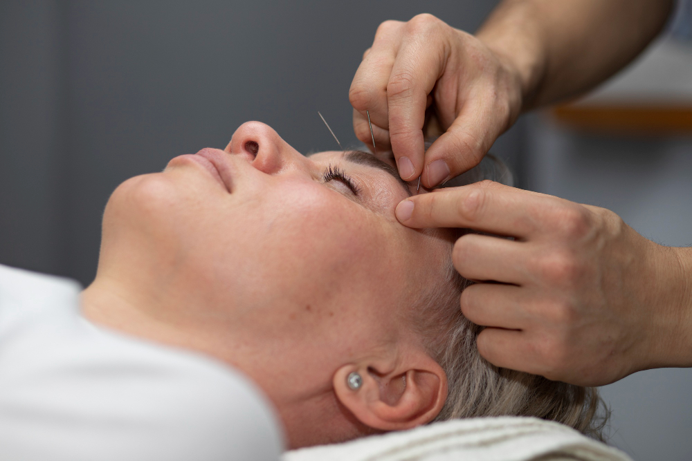 acupuncture for migraines