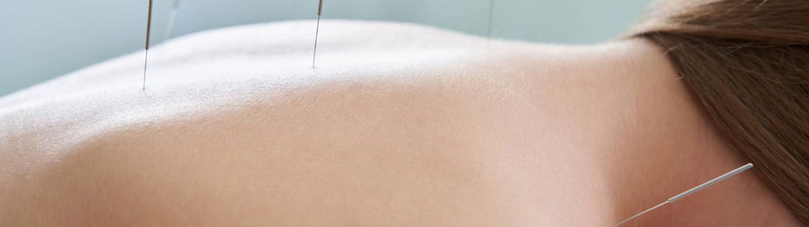 purchase acupuncture gift certificate